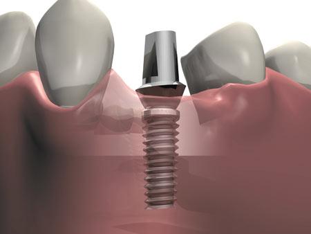 Отзывы об имплантации зубов