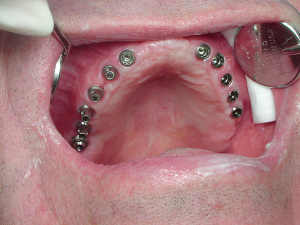 Отзывы об имплантации зубов